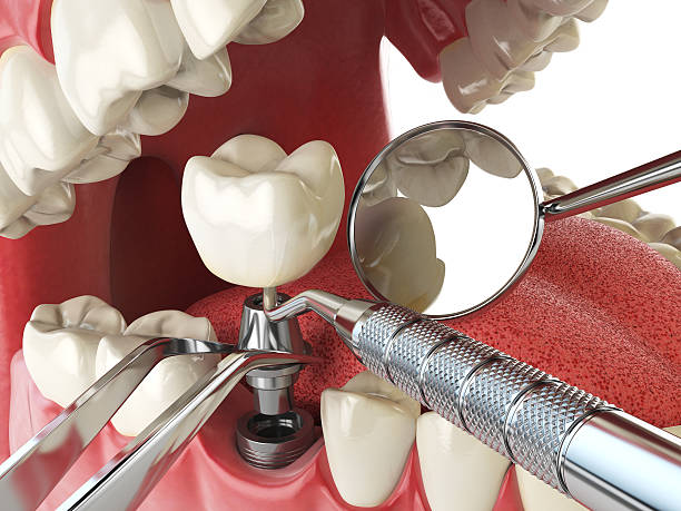 Best Emergency Broken Tooth Repair in Mineral Point, WI